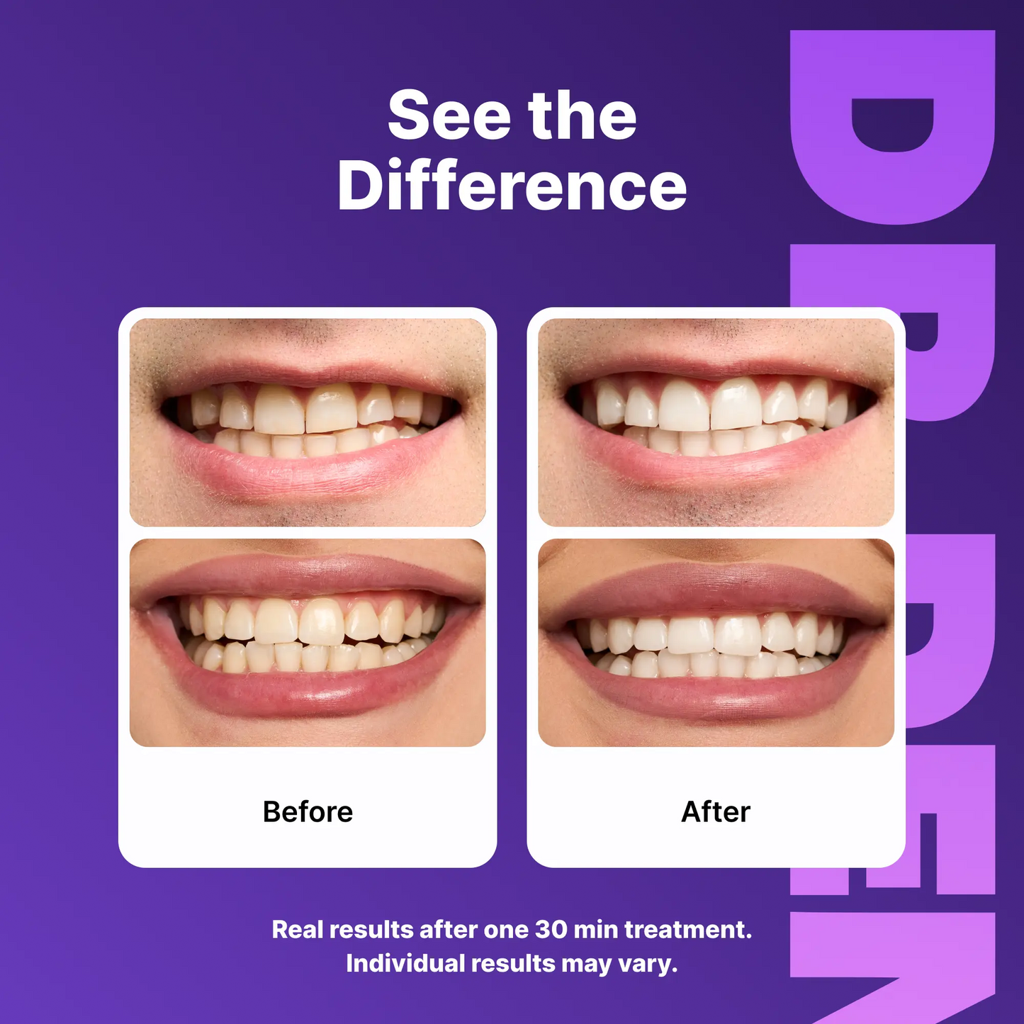Experience a Dazzling Smile with DRDENT Purple Teeth Whitening Strips - 7/21 Sessions of Gentle, Peroxide-Free Whitening for Sensitive Teeth