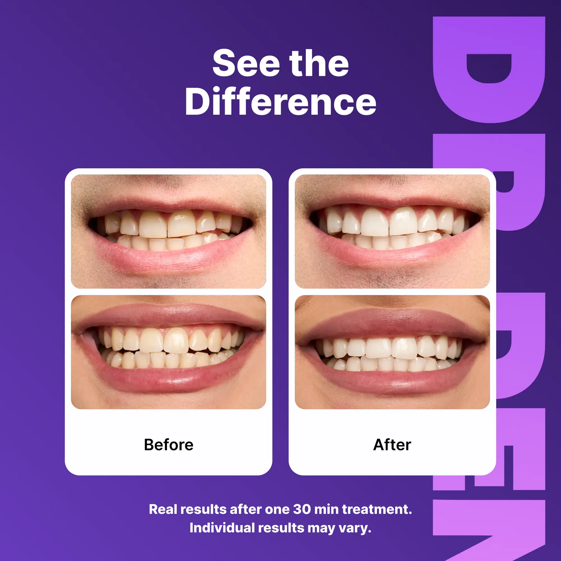 Experience a Dazzling Smile with DRDENT Purple Teeth Whitening Strips - 7/21 Sessions of Gentle, Peroxide-Free Whitening for Sensitive Teeth