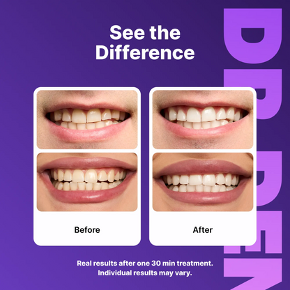 Experience a Dazzling Smile with DRDENT Purple Teeth Whitening Strips - 7/21 Sessions of Gentle, Peroxide-Free Whitening for Sensitive Teeth